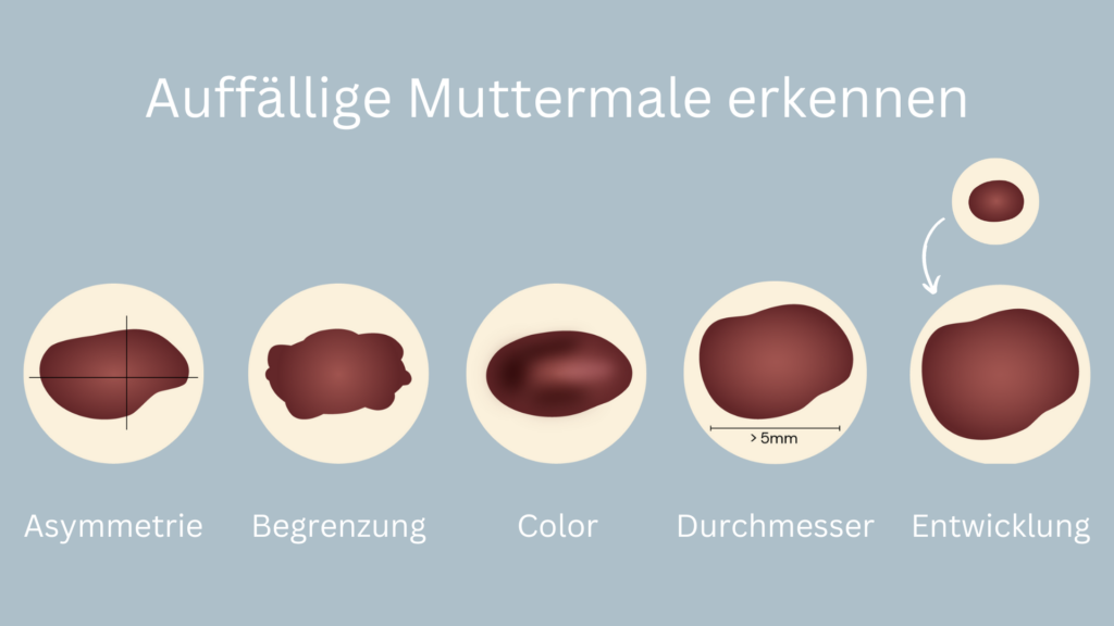 Die ABCDE-Regel verrät im Notfall schnell mehr über Hautveränderungen auf der Haut