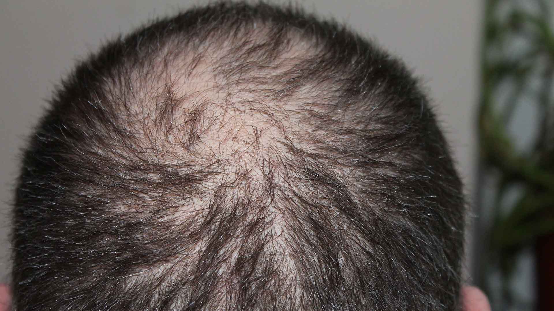 Mann mit diffusem Haarausfall